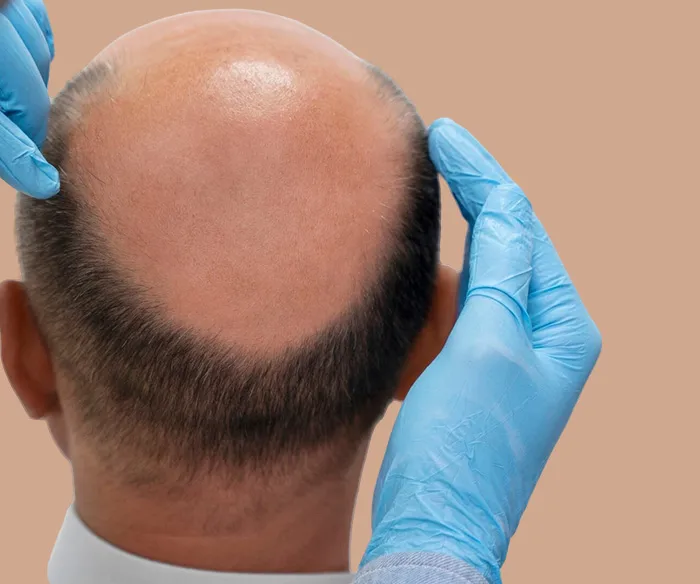 greffe de cheveux Sousse Tunisie